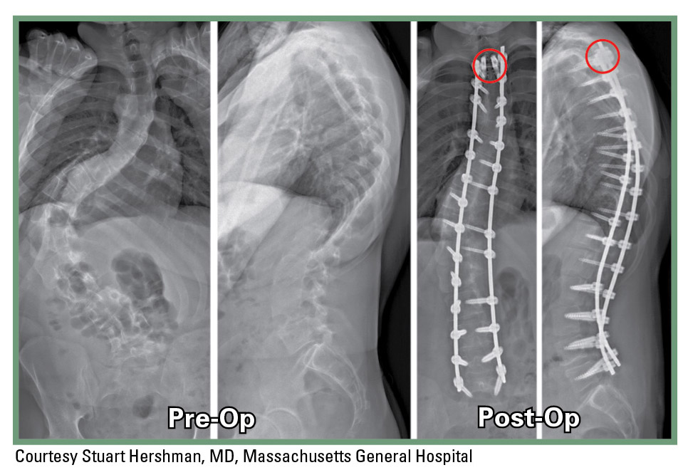 pre operation and post operation x-ray photos