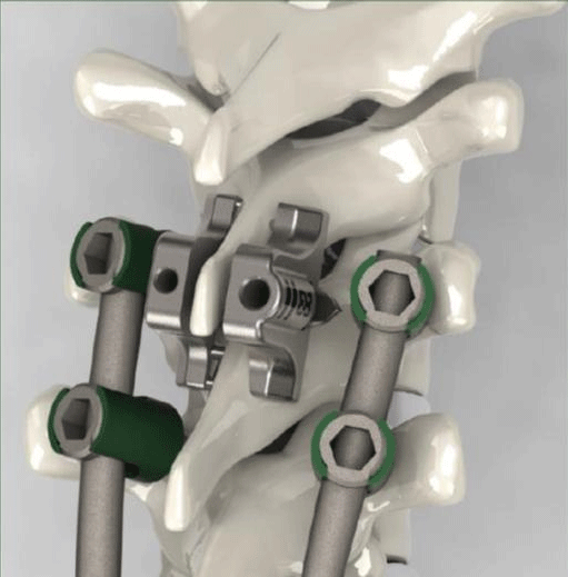 Spinal Insert